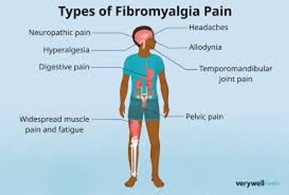 Illustration of widespread pain points associated with fibromyalgia New Day Therapies Hull